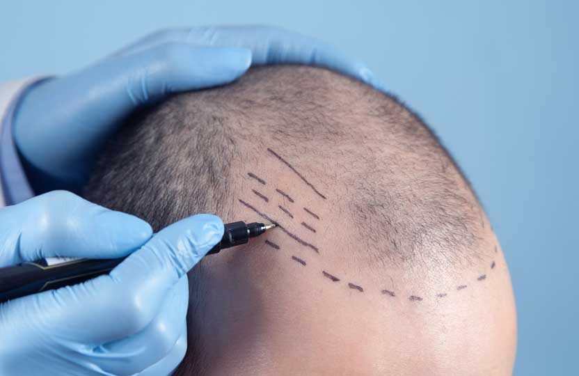 Hair Transplantation